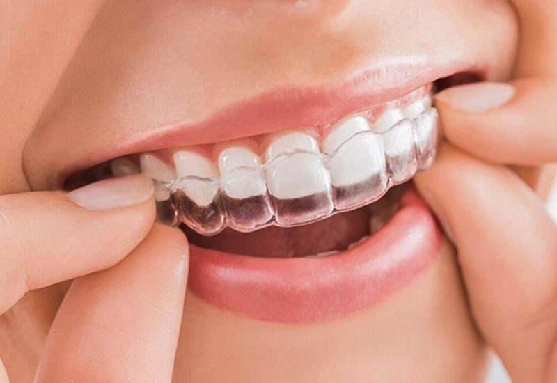 CHỈNH NHA LÀ GÌ? NHỮNG PHƯƠNG PHÁP CHỈNH NHA PHỔ BIẾN HIỆN NAY