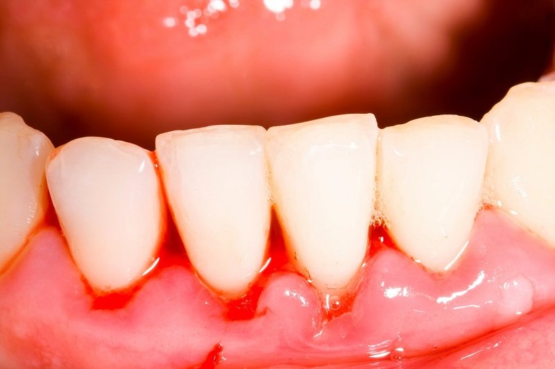 BỆNH NHA CHU LÀ GÌ? NHẬN BIẾT VÀ ĐIỀU TRỊ BỆNH NHA CHU